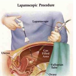 لاپاراسکوپی چیست؟